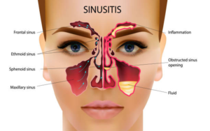 Penyebab Penyakit Sinusitis